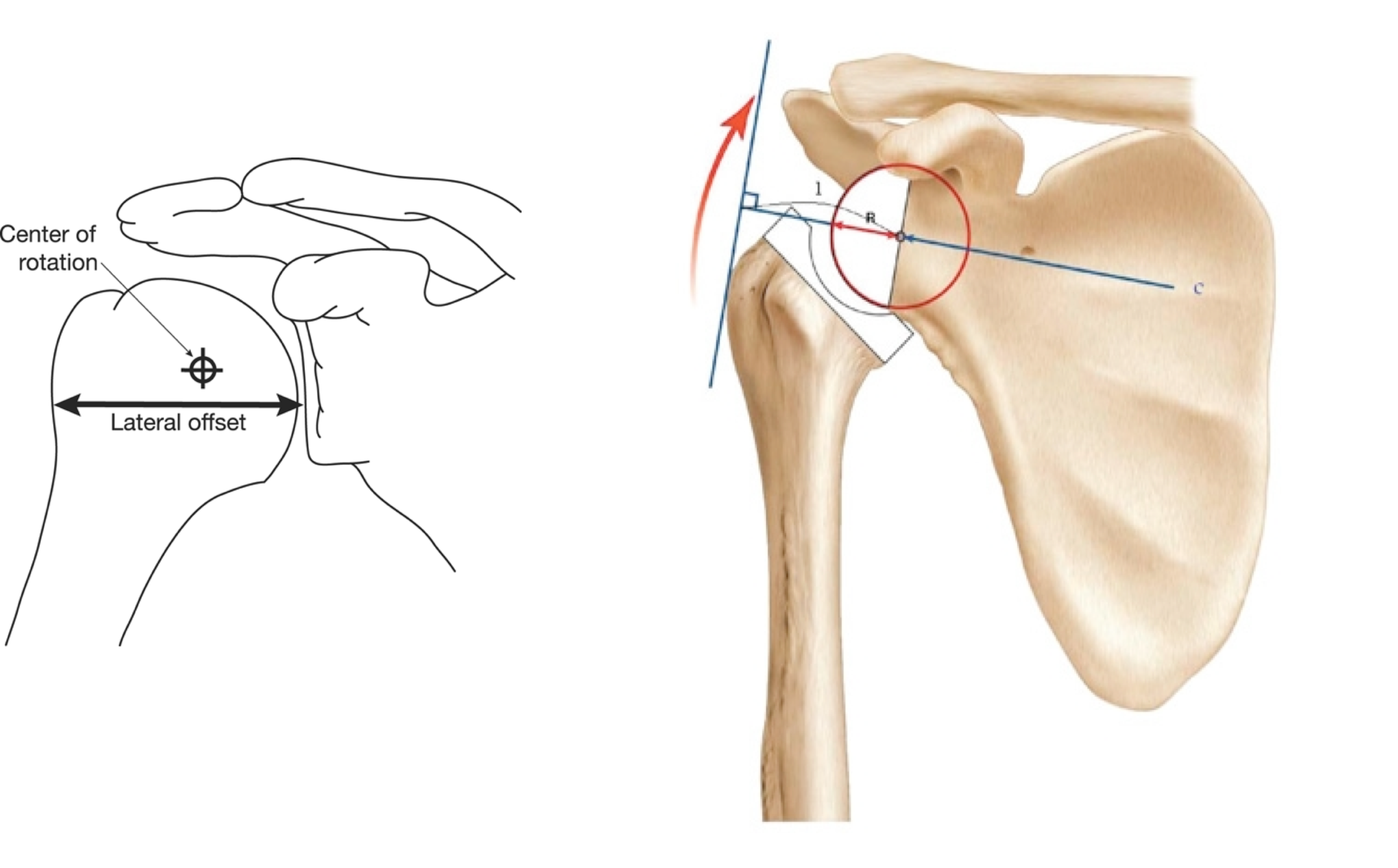 reverse shoulder replacement