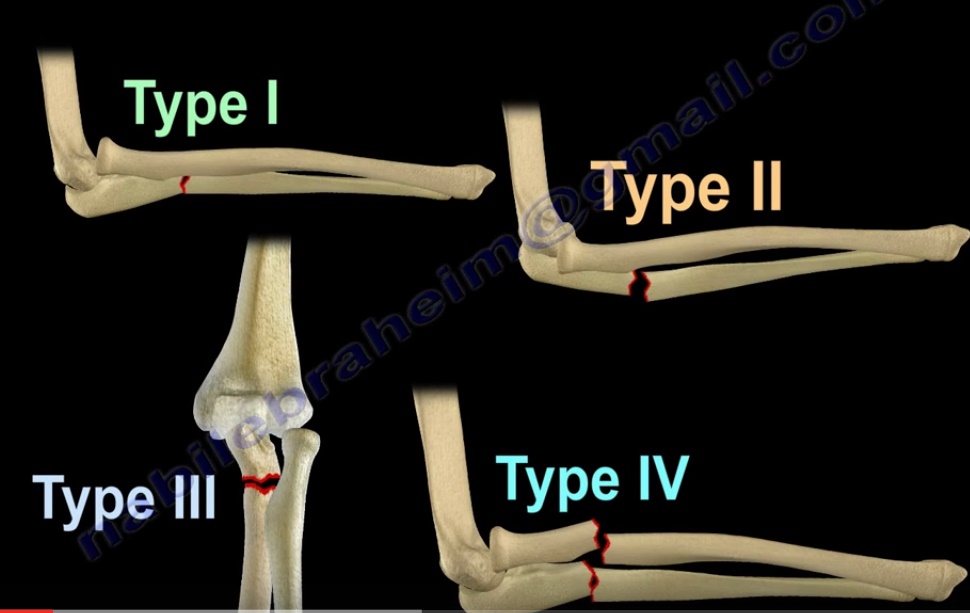 surgery for monteggia fracture