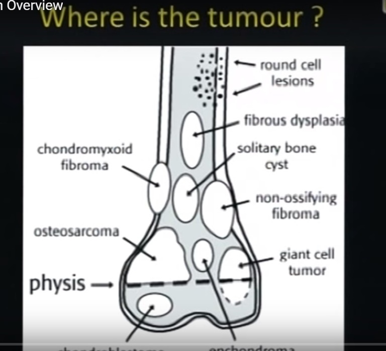 benign-bone-tumours-orthopaedicprinciples