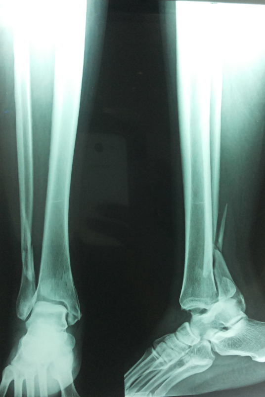 lateral malleolus fracture rehabilitation protocol brigham