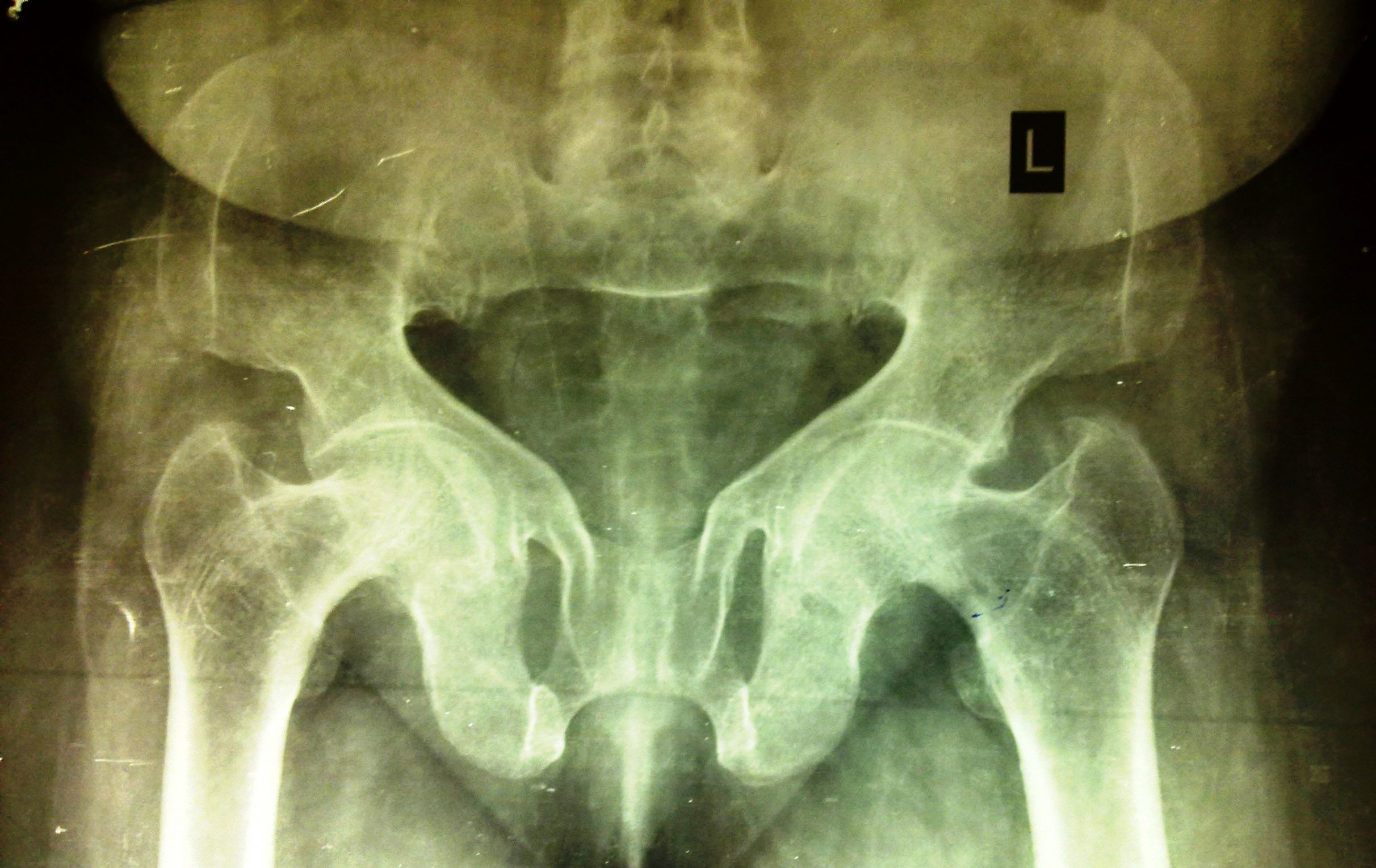 achondroplasia x ray vs normal