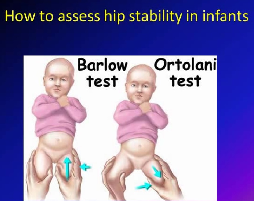 Developmental Dysplasia Of The Hip OrthopaedicPrinciples