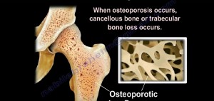 2 bone mass and osteoporosisJ