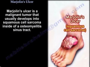 Marjolins ulcer