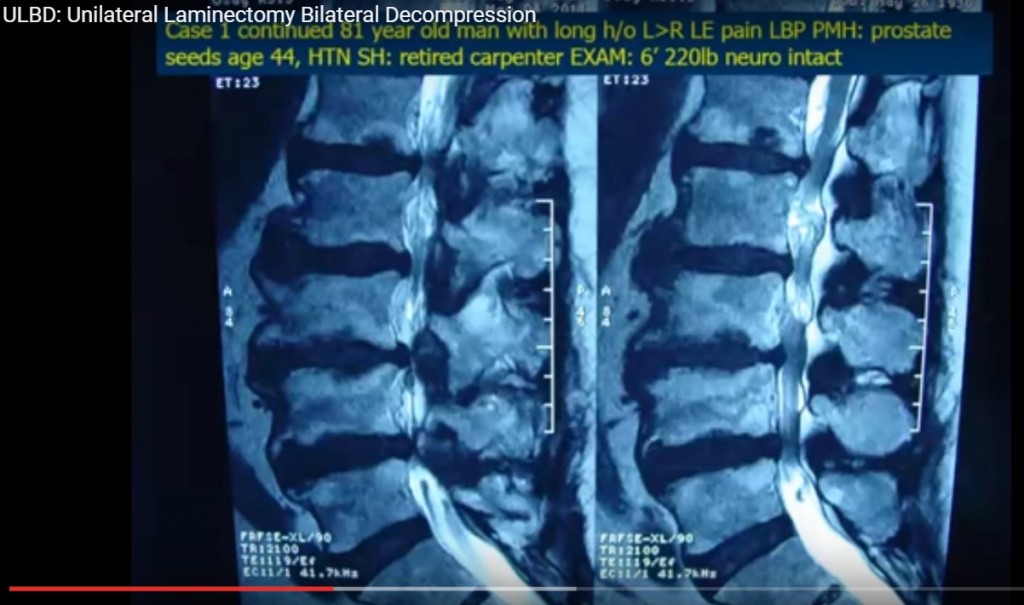 Spinal Canal Stenosis Orthopaedicprinciples