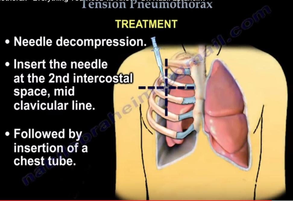 tension-pneumothorax-orthopaedicprinciples