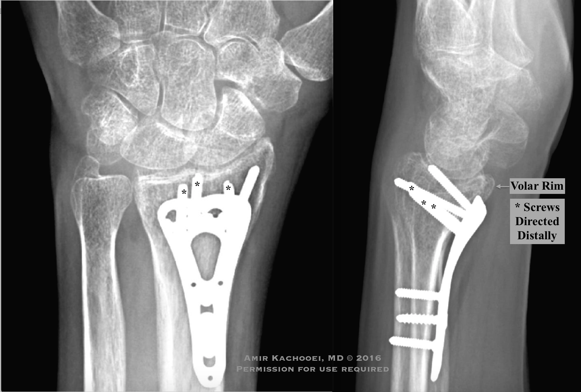 Fractures Of The Right Distal Radius And Ulna With Fi