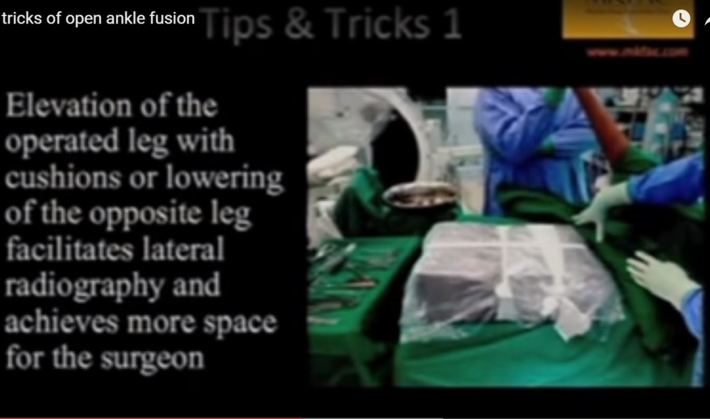 tips and tricks ankle fusion