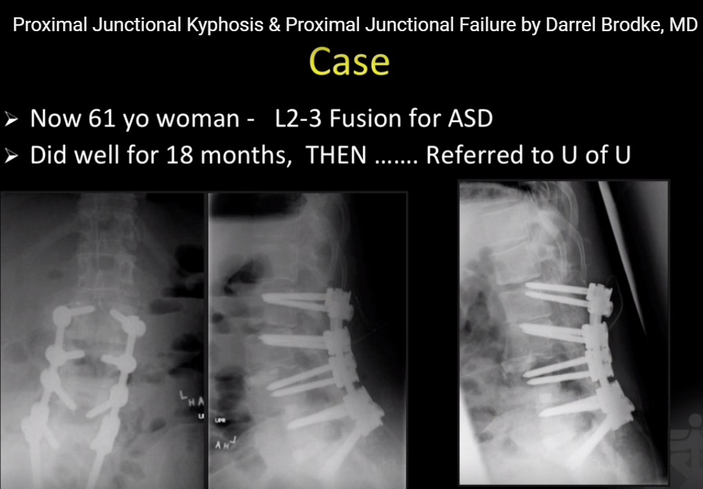 Proximal Junctional Kyphosis and Junctional Failure