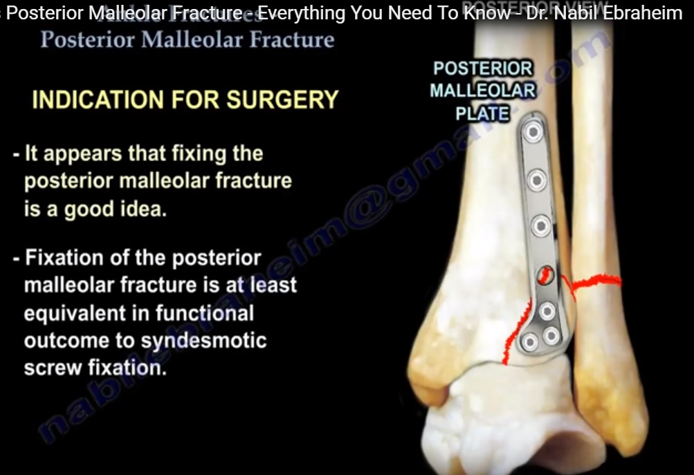 ankle brace for lateral malleolus fracture