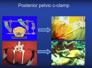 Pelvic Fracture Emergent Treatment OrthopaedicPrinciples