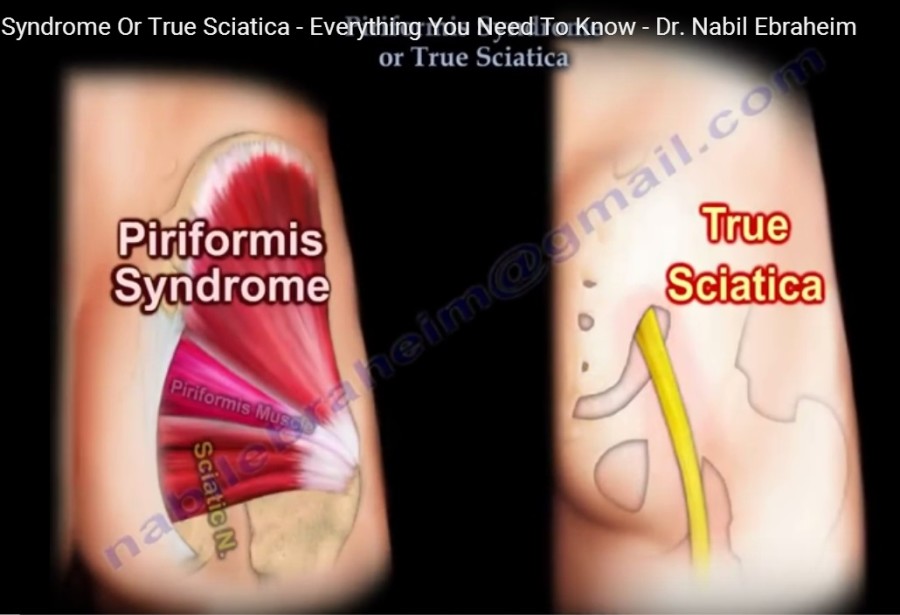 Piriformis Syndrome Orthopaedicprinciples