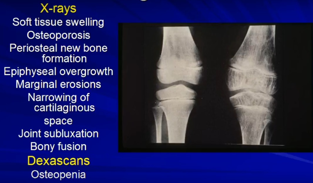 juvenile idiopathic arthritis icd 10