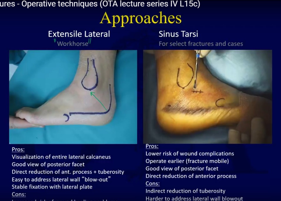 calcaneus fracture classification