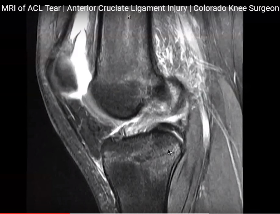 mri-in-anterior-cruciate-ligament-tear-orthopaedicprinciples