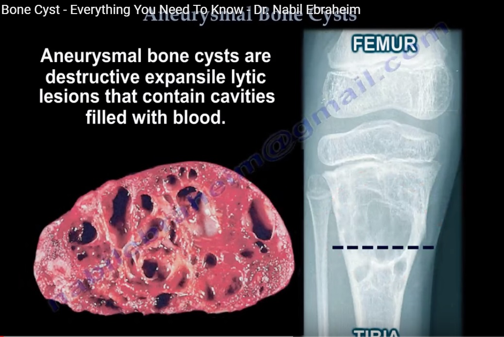 Aneurysmal Bone Cyst