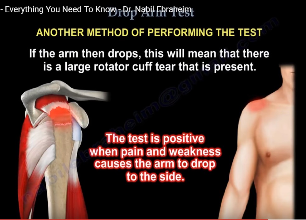 drop-arm-test-for-the-shoulder-orthopaedicprinciples