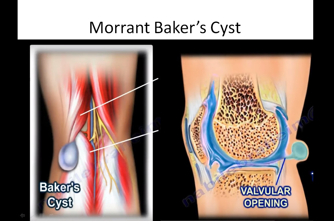 morrant-baker-s-cyst-orthopaedicprinciples