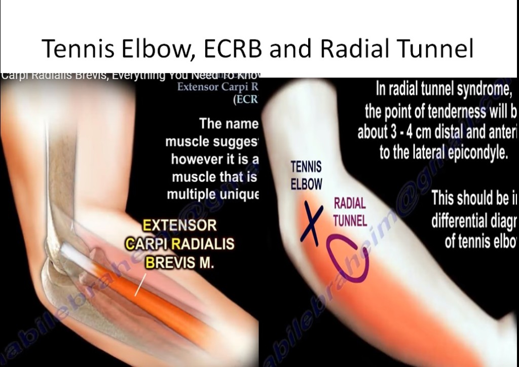 Tennis Elbow ECRB And Radial Tunnel Syndrome OrthopaedicPrinciples