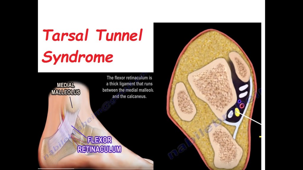 Tarsal Tunnel Syndrome Orthopaedicprinciples