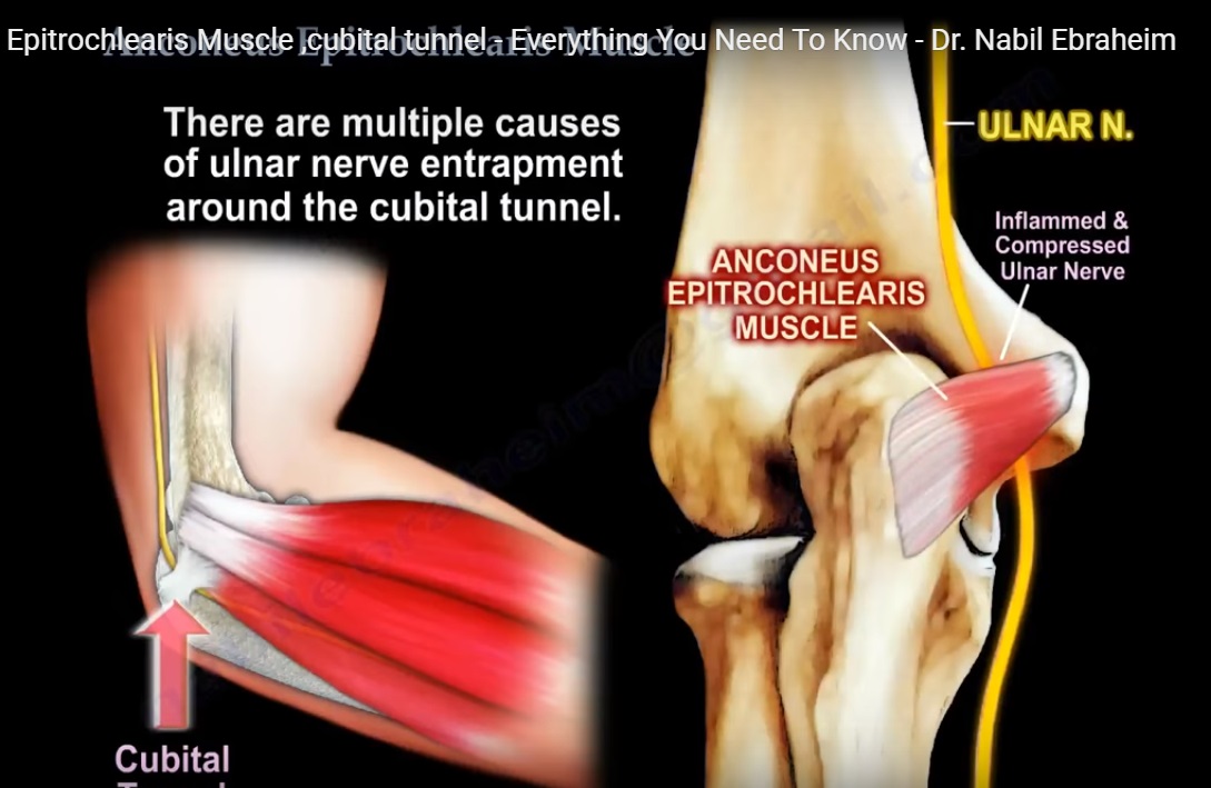 Cubital Tunnel Syndrome Ulnar Nerve Entrapment - Everything You Need To  Know - Dr. Nabil Ebraheim 