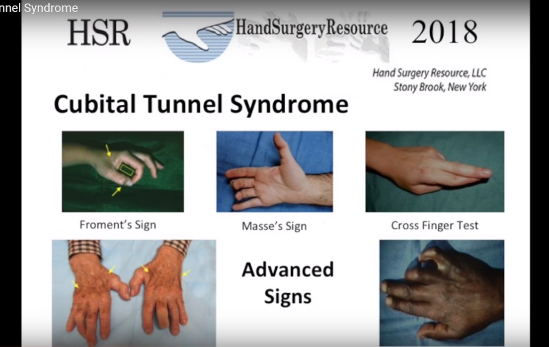 Cubital Tunnel Syndrome - Nonsurgical Options - Orlando Hand Surgery  Associates