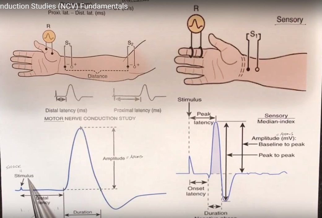 emg-nerve-conduction-test-with-crps-youtube