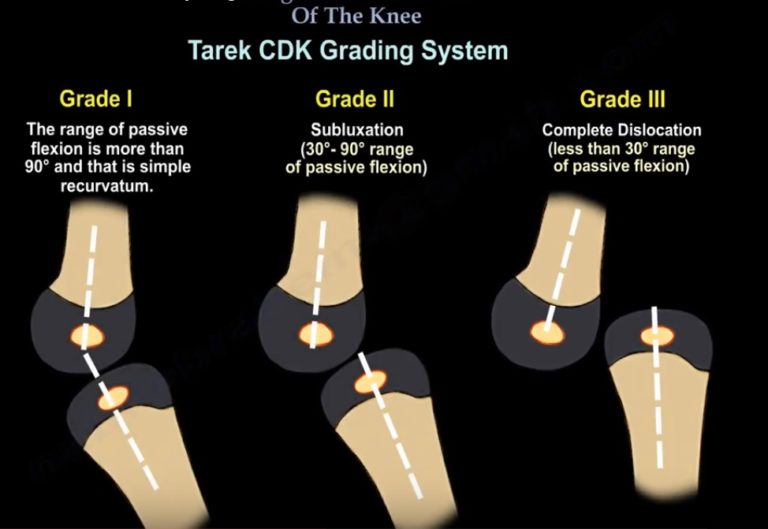 Congenital Dislocation Of The Knee OrthopaedicPrinciples