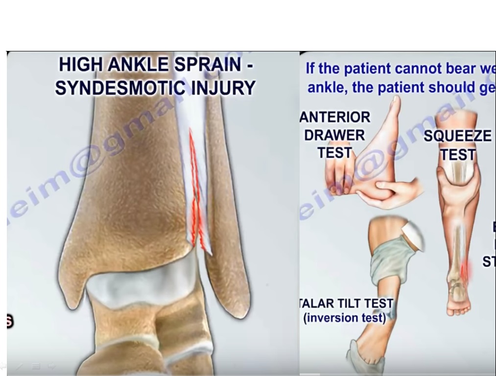 Ankle Orthopaedic Test: Talar tilt