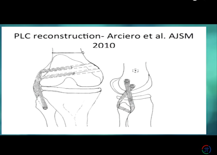 Posterolateral Corner Reconstruction —