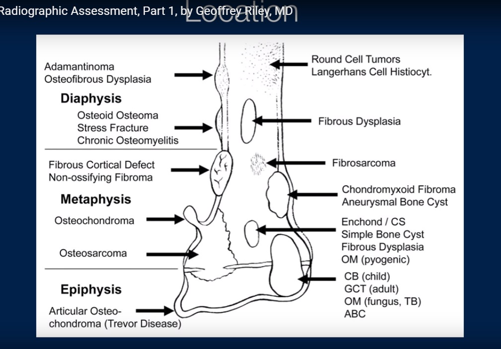 cystic-lesions-of-bone-how-to-diagnose-and-treat-these-lesions-my-xxx