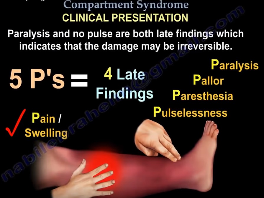 Compartment Syndrome Therapy