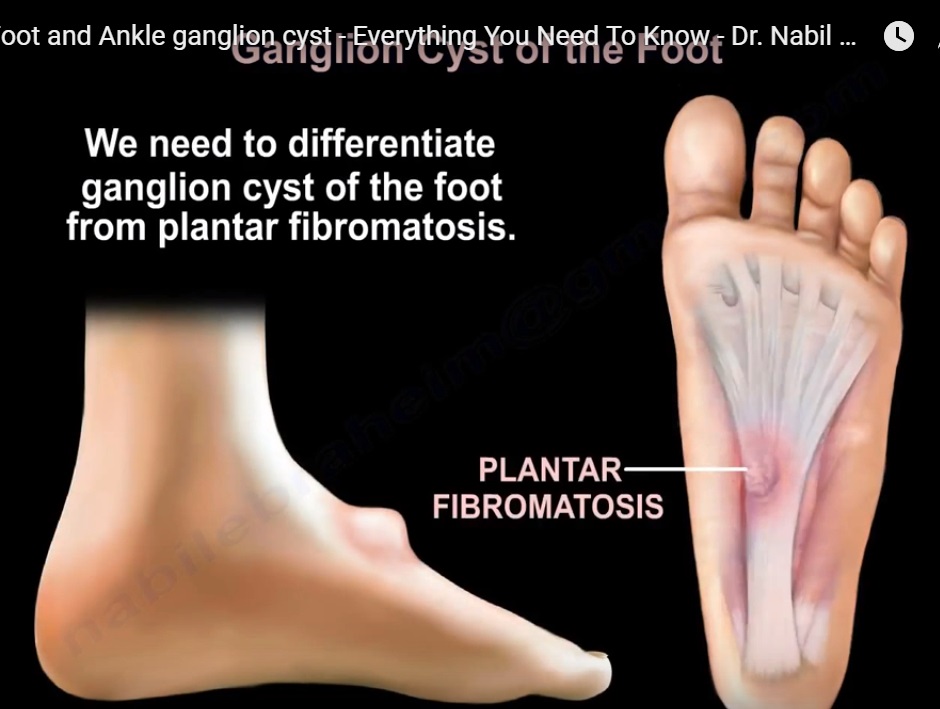 ganglion-cyst-of-foot-and-ankle-orthopaedicprinciples