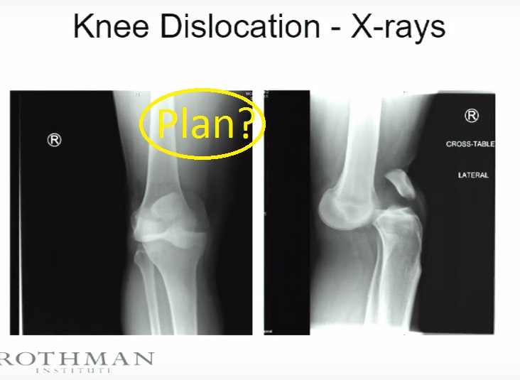 Knee Dislocation Panel Discussion OrthopaedicPrinciples