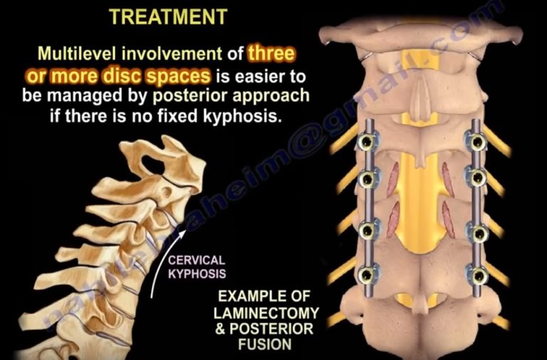 Cervical Myelopathy Clinical Signs OrthopaedicPrinciples