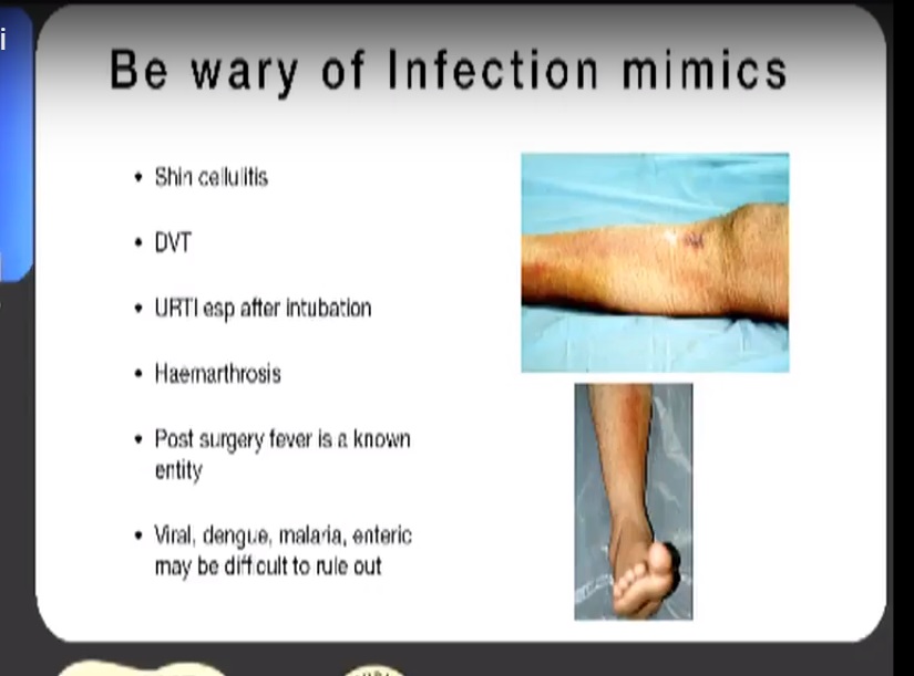 Managing Infection After ACL Reconstruction OrthopaedicPrinciples