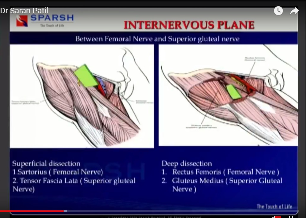 Direct Anterior Approach for Total Hip Replacement