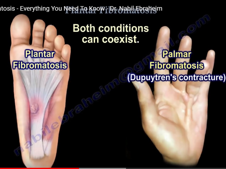 plantar-fibromatosis-orthopaedicprinciples