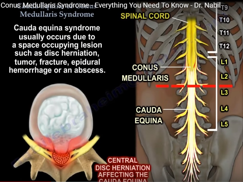 cauda equina syndrome vs conus medullaris
