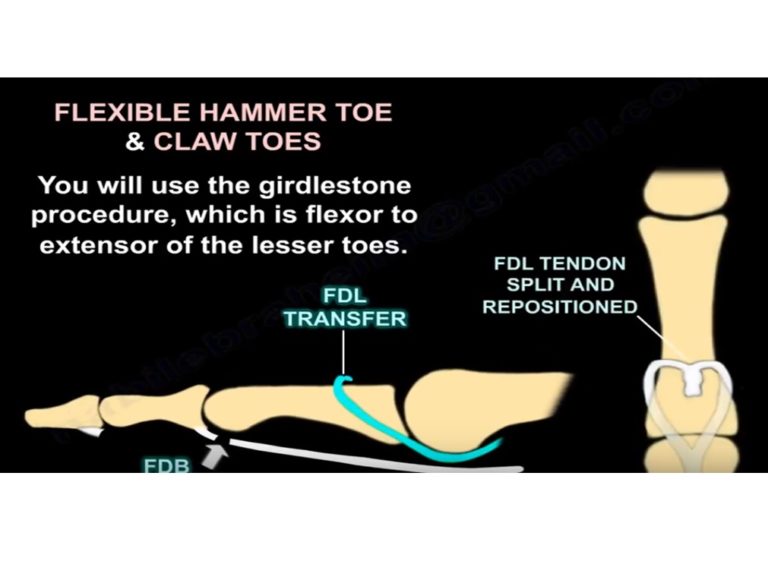 Tendon Transfers In Foot And Ankle Orthopaedicprinciples