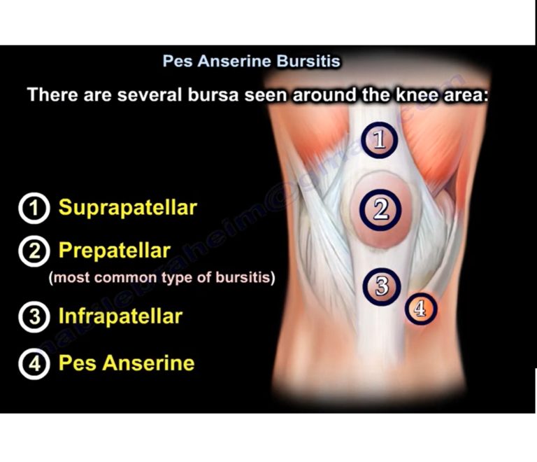 Pes Anserine Bursitis OrthopaedicPrinciples