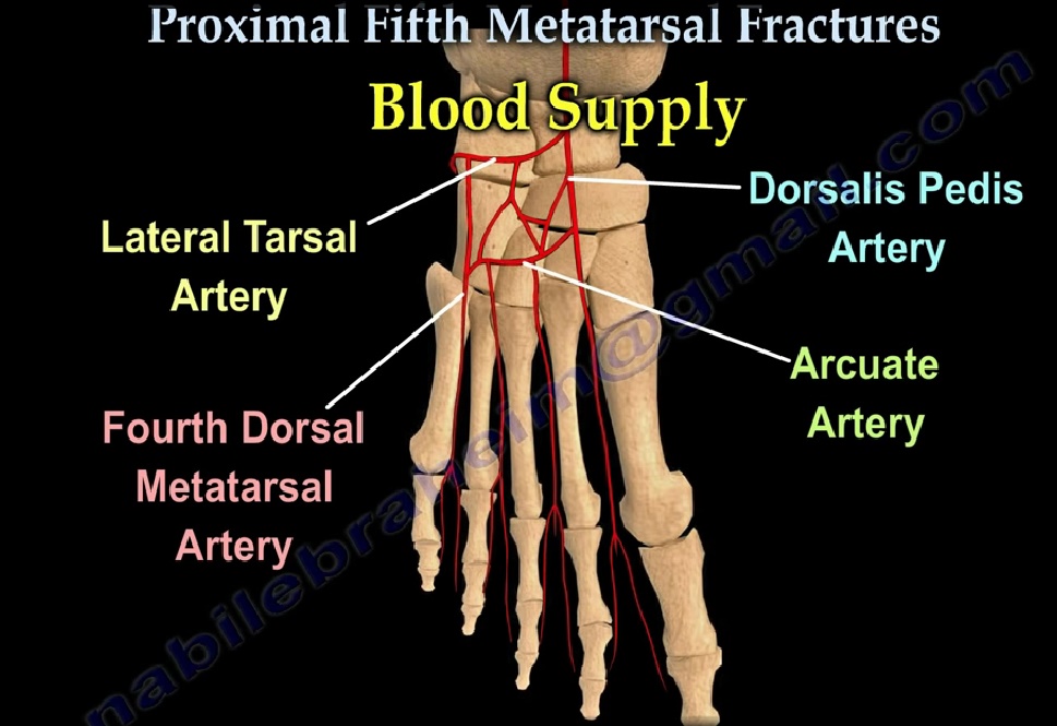 5th metatarsal fracture child