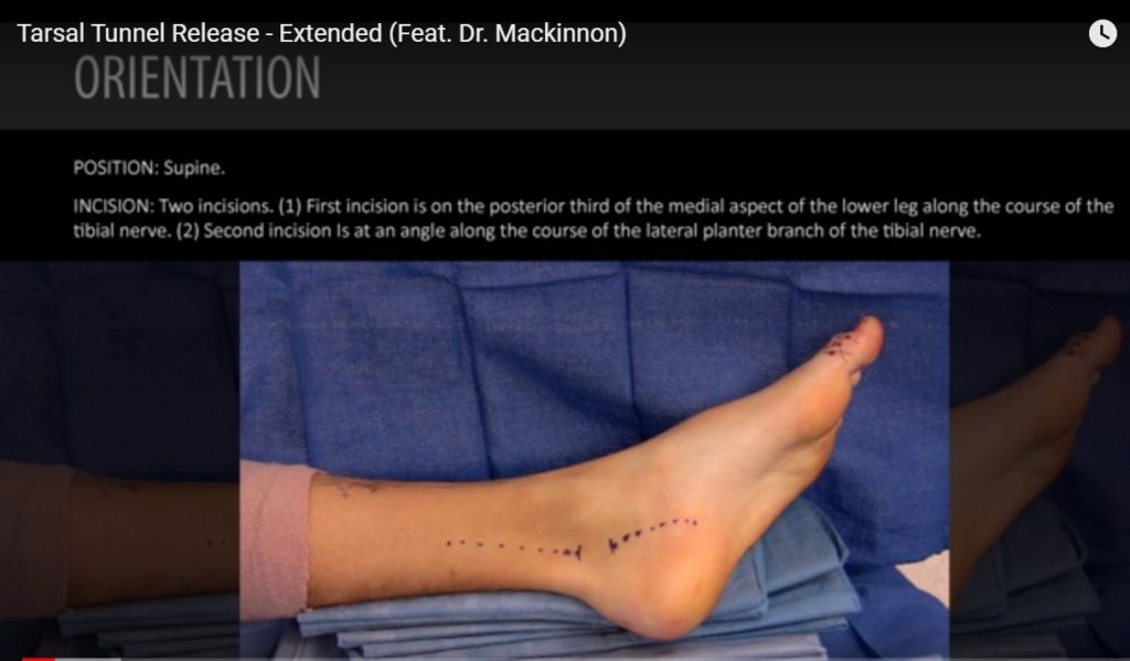 Surgical Release For Tarsal Tunnel Syndrome OrthopaedicPrinciples Com