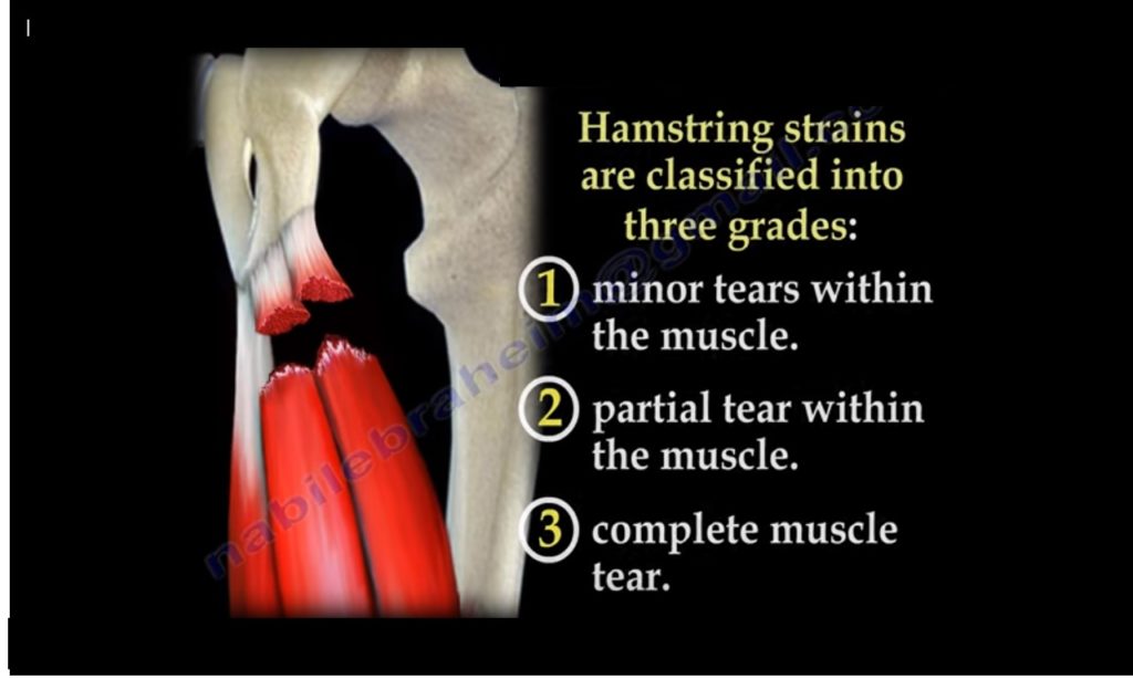 Hamstring Injury Symptoms Recovery Treatment - vrogue.co