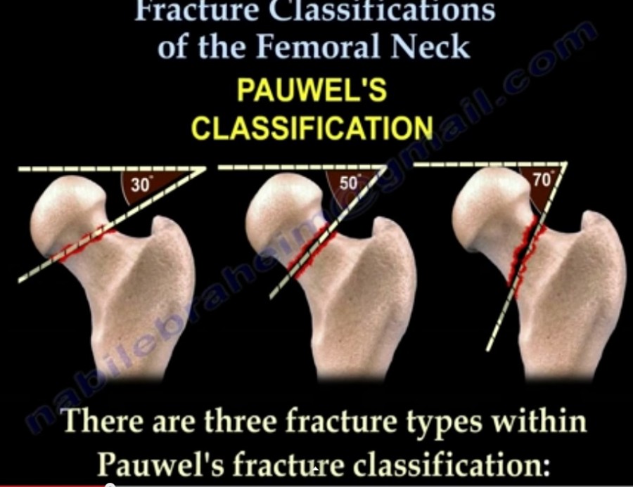 Femoral Neck Fracture Classification — OrthopaedicPrinciples.com