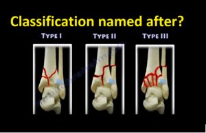 Tibial Pilon Fracture Classification — OrthopaedicPrinciples.com