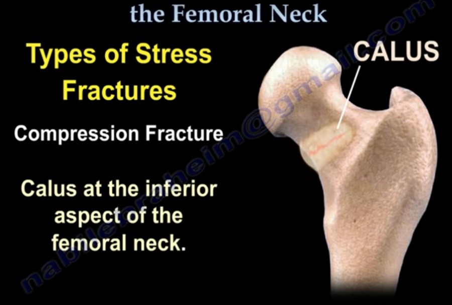 Femoral Neck Stress Fractures — 5276