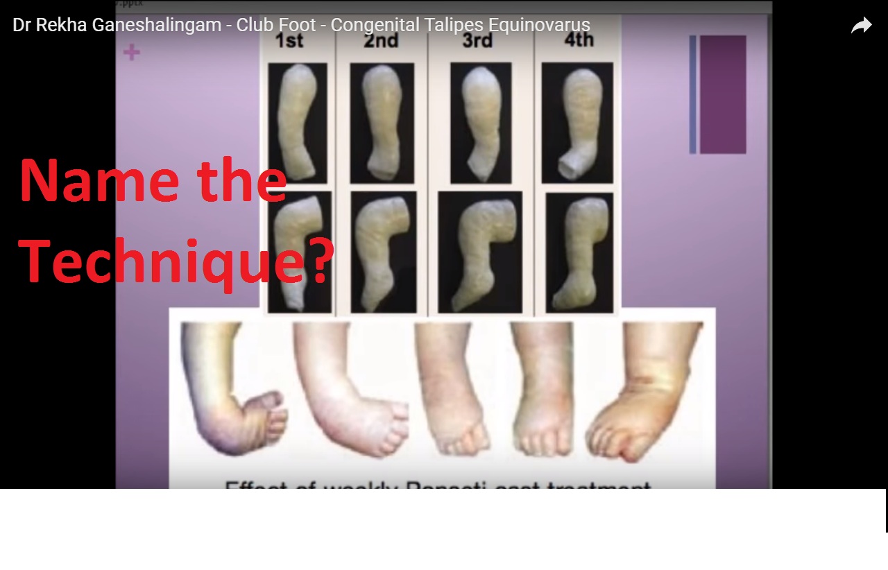 Basics Of Clubfoot Orthopaedicprinciples Com