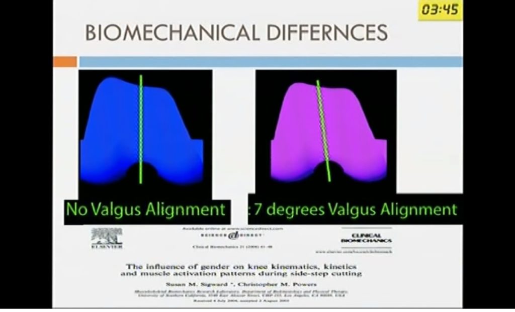 Functional Alignment : Knee Arthroplasty — OrthopaedicPrinciples.com