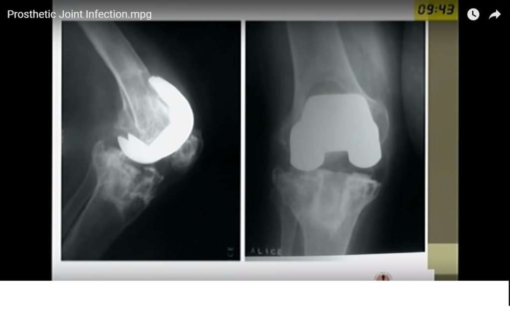 icd 10 code for left hip prosthetic joint infection